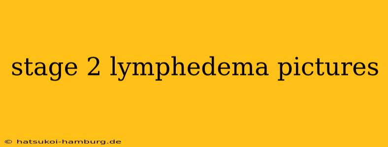 stage 2 lymphedema pictures